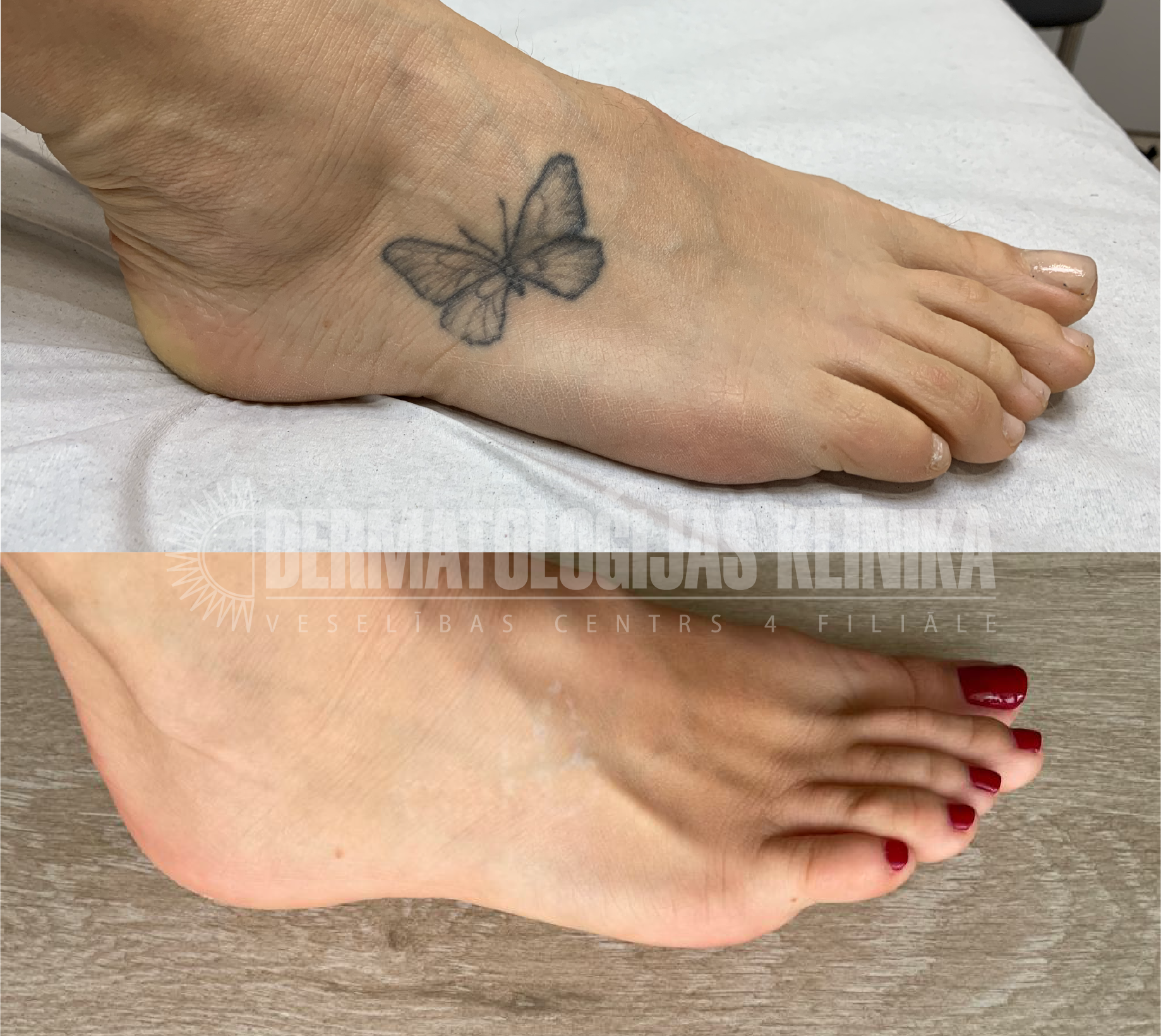 Kājas ar tetovējumu pirms un pēc tetovējumu likvidēšanas